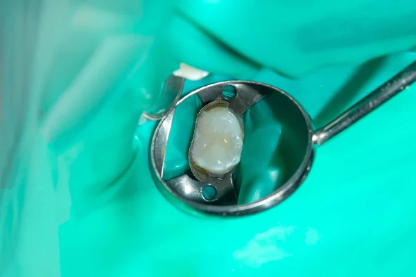 Крупным Планом Гнилого Кариозного Зуба Человека Стадии Лечения Стоматологической Клинике — стоковое фото