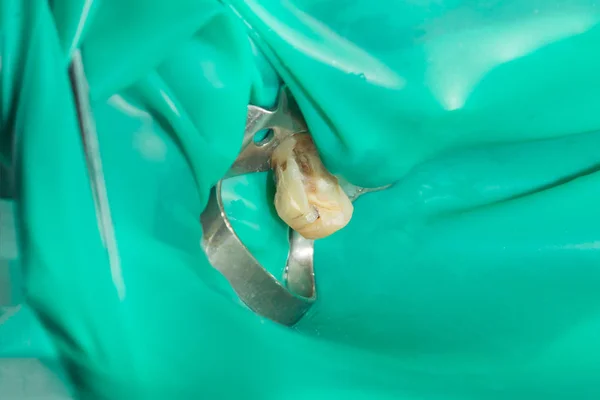 Close Dente Cariado Podre Humano Fase Tratamento Uma Clínica Odontológica — Fotografia de Stock