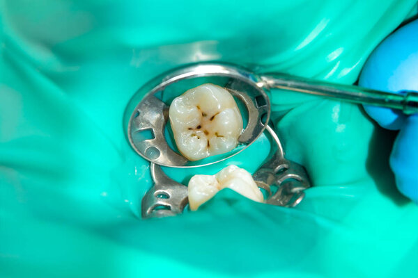 крупным планом гнилого кариозного зуба человека на стадии лечения в стоматологической клинике. Использование системы резиновых плотин с латексными шарфами и металлическими зажимами, производство фотополимерных композитных пломб
