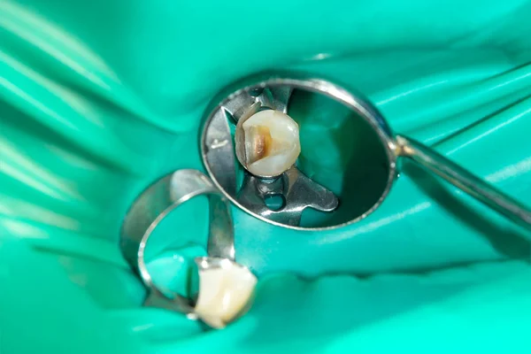 Bir Insan Çürük Carious Diş Tedavi Aşamasında Bir Diş Kliniğinde — Stok fotoğraf