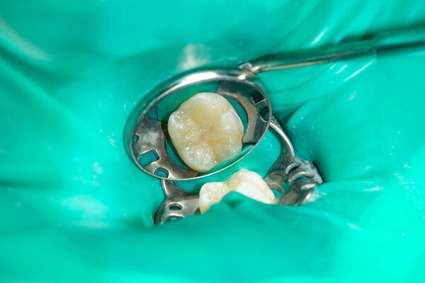 крупным планом гнилого кариозного зуба человека на стадии лечения в стоматологической клинике. Использование системы резиновых плотин с латексными шарфами и металлическими зажимами, производство фотополимерных композитных пломб
