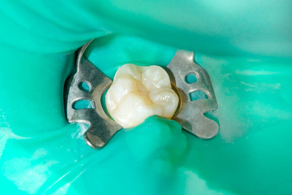 крупным планом гнилого кариозного зуба человека на стадии лечения в стоматологической клинике. Использование системы резиновых плотин с латексными шарфами и металлическими зажимами, производство фотополимерных композитных пломб
