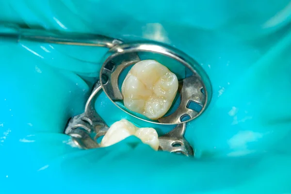 Close Dente Cariado Podre Humano Fase Tratamento Uma Clínica Odontológica — Fotografia de Stock