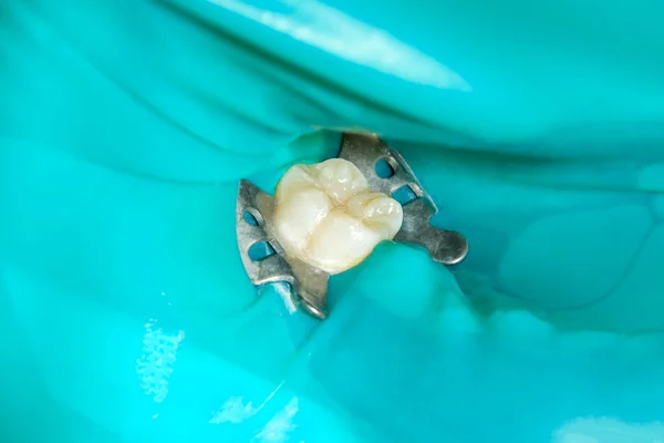 Close Dente Cariado Podre Humano Fase Tratamento Uma Clínica Odontológica — Fotografia de Stock