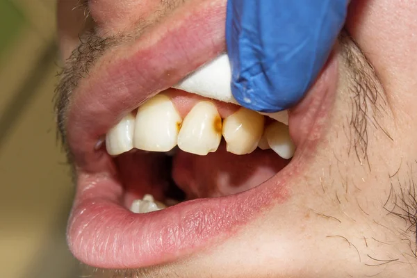 Caries Spoiled Tooth Closeup Photographed Dental Mirror — Stock Photo, Image