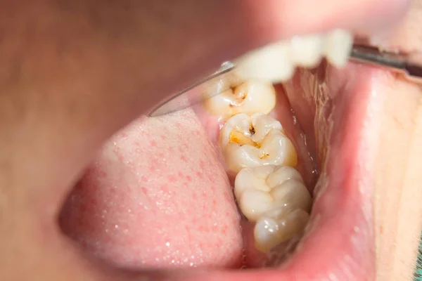 Close Dente Cariado Podre Humano Fase Tratamento Uma Clínica Odontológica — Fotografia de Stock