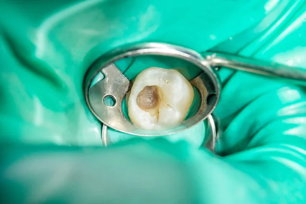 Tratamento Cárie Dente Humano Close Conceito Restauração Dentária Dente Com — Fotografia de Stock
