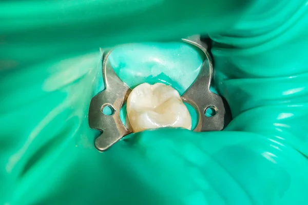 Tratamiento Caries Del Diente Humano Primer Plano Concepto Restauración Dental — Foto de Stock
