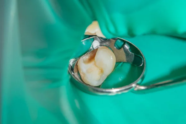 Close Dente Cariado Podre Humano Fase Tratamento Uma Clínica Odontológica — Fotografia de Stock