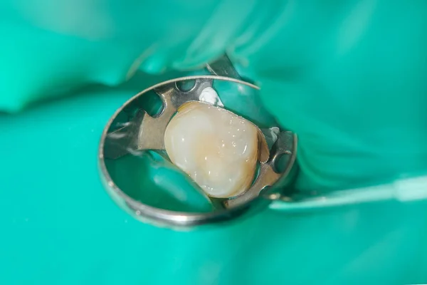 Tratamentul Cariilor Unui Dinte Uman Aproape Conceptul Restaurare Dentară Dintelui — Fotografie, imagine de stoc