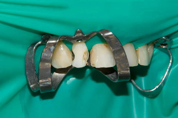 Крупным Планом Гнилого Кариозного Зуба Человека Стадии Лечения Стоматологической Клинике — стоковое фото