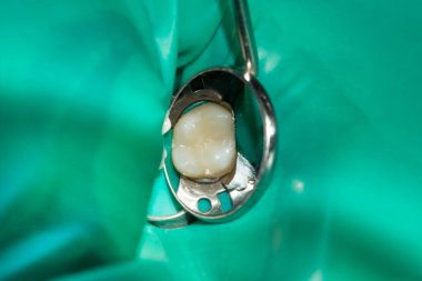 bir insan çürük carious diş tedavi aşamasında bir diş kliniğinde yakın çekim. Kauçuk baraj sistemiyle lateks eşarp ve metal klipleri, photopolymeric kompozit dolgular üretiminde kullanımı