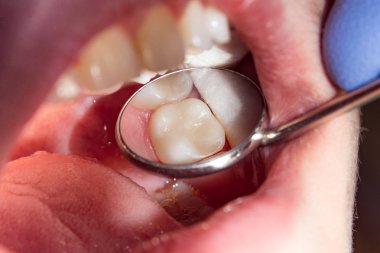 close-up of a human rotten carious tooth at the treatment stage in a dental clinic. The use of rubber dam system with latex scarves and metal clips, production of photopolymeric composite fillings clipart