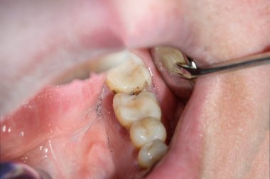 bir insan çürük carious diş tedavi aşamasında bir diş kliniğinde yakın çekim. Kauçuk baraj sistemiyle lateks eşarp ve metal klipleri, photopolymeric kompozit dolgular üretiminde kullanımı