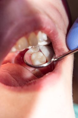 bir insan çürük carious diş tedavi aşamasında bir diş kliniğinde yakın çekim. Kauçuk baraj sistemiyle lateks eşarp ve metal klipleri, photopolymeric kompozit dolgular üretiminde kullanımı
