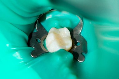 bir insan çürük carious diş tedavi aşamasında bir diş kliniğinde yakın çekim. Kauçuk baraj sistemiyle lateks eşarp ve metal klipleri, photopolymeric kompozit dolgular üretiminde kullanımı