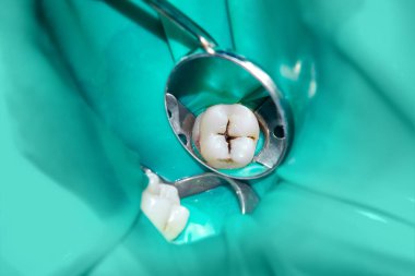 bir insan çürük carious diş tedavi aşamasında bir diş kliniğinde yakın çekim. Kauçuk baraj sistemiyle lateks eşarp ve metal klipleri, photopolymeric kompozit dolgular üretiminde kullanımı
