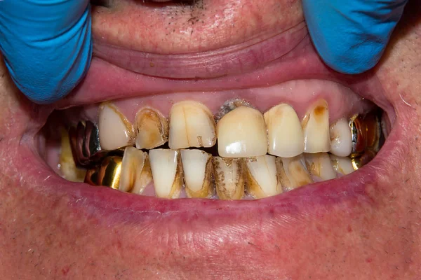 Detail Člověka Shnilé Zkažený Zub Fázi Léčby Zubní Klinice Použití — Stock fotografie