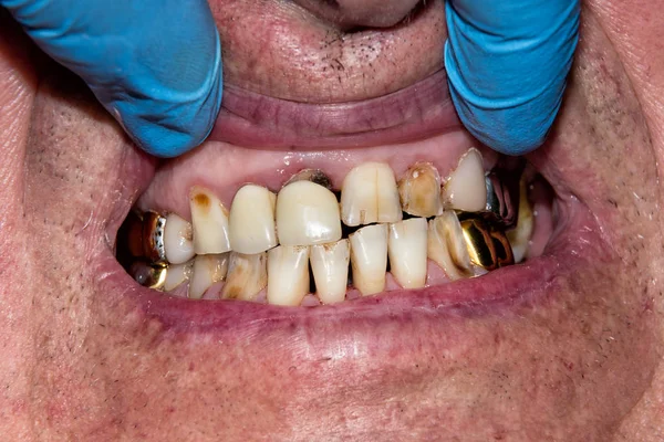 Traitement Carie Une Dent Humaine Gros Plan Concept Restauration Dentaire — Photo