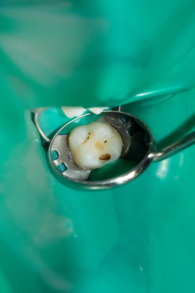 歯科医院で治療の段階で腐った人間の齲蝕歯のクローズ アップ ラテックスのスカーフと金属製のクリップのゴム システム Photopolymeric コンポジット充填材料の生産の使用 — ストック写真