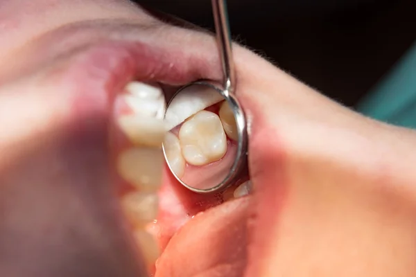Close Dente Cariado Podre Humano Fase Tratamento Uma Clínica Odontológica — Fotografia de Stock