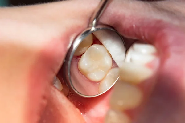 Close Dente Cariado Podre Humano Fase Tratamento Uma Clínica Odontológica — Fotografia de Stock