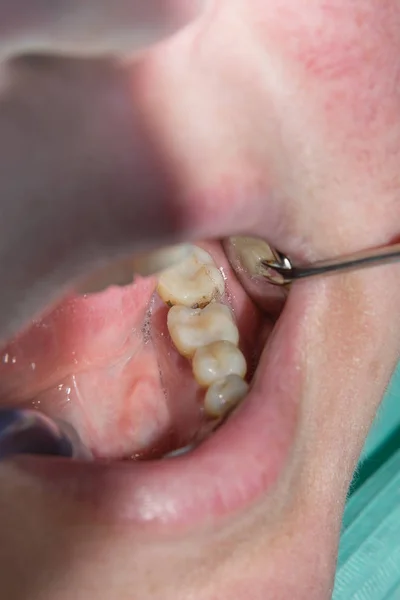 Close Dente Cariado Podre Humano Fase Tratamento Uma Clínica Odontológica — Fotografia de Stock