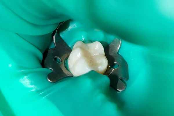 在牙科诊所的治疗阶段 一个人腐烂的龋齿牙齿的特写 橡胶坝系统与乳胶围巾和金属夹的使用 Photopolymeric 复合填料的生产 — 图库照片