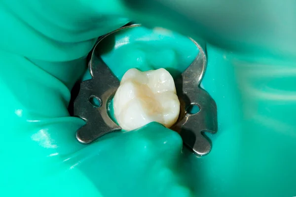 Close Dente Cariado Podre Humano Fase Tratamento Uma Clínica Odontológica — Fotografia de Stock