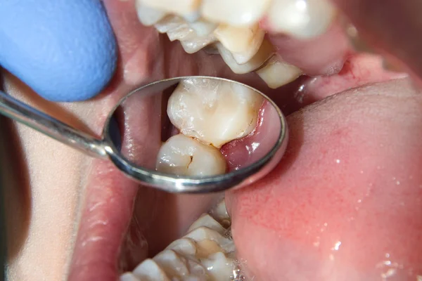 Bir Insan Çürük Carious Diş Tedavi Aşamasında Bir Diş Kliniğinde — Stok fotoğraf