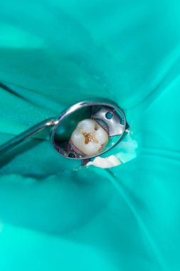 bir insan çürük carious diş tedavi aşamasında bir diş kliniğinde yakın çekim. Kauçuk baraj sistemiyle lateks eşarp ve metal klipleri, photopolymeric kompozit dolgular üretiminde kullanımı