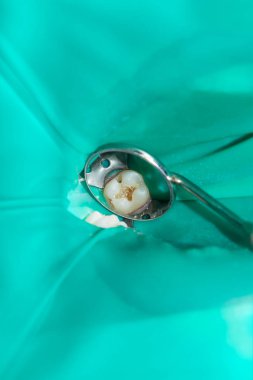 bir insan çürük carious diş tedavi aşamasında bir diş kliniğinde yakın çekim. Kauçuk baraj sistemiyle lateks eşarp ve metal klipleri, photopolymeric kompozit dolgular üretiminde kullanımı