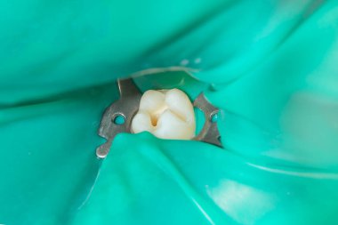 bir insan çürük carious diş tedavi aşamasında bir diş kliniğinde yakın çekim. Kauçuk baraj sistemiyle lateks eşarp ve metal klipleri, photopolymeric kompozit dolgular üretiminde kullanımı