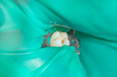 bir insan çürük carious diş tedavi aşamasında bir diş kliniğinde yakın çekim. Kauçuk baraj sistemiyle lateks eşarp ve metal klipleri, photopolymeric kompozit dolgular üretiminde kullanımı