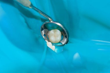 bir insan çürük carious diş tedavi aşamasında bir diş kliniğinde yakın çekim. Kauçuk baraj sistemiyle lateks eşarp ve metal klipleri, photopolymeric kompozit dolgular üretiminde kullanımı
