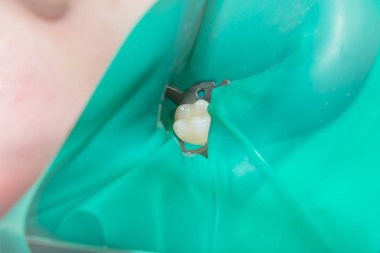 bir insan çürük carious diş tedavi aşamasında bir diş kliniğinde yakın çekim. Kauçuk baraj sistemiyle lateks eşarp ve metal klipleri, photopolymeric kompozit dolgular üretiminde kullanımı
