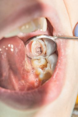 bir insan çürük carious diş tedavi aşamasında bir diş kliniğinde yakın çekim. Kauçuk baraj sistemiyle lateks eşarp ve metal klipleri, photopolymeric kompozit dolgular üretiminde kullanımı