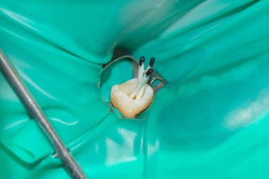 Fotoğraf endodontik tedavi alt azı kalıcı diş Endodontik dosyasıyla molar diş kanallar ile apex arama, diş cofferdam tarafından bağlı kelepçe ile