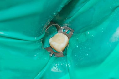 Diş tedavisi diş kliniği. Carious çürük diş yakın çekim makro. Endodontik kanallar tedavisinde