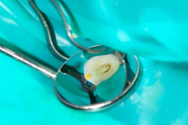 Fotoğraf endodontik tedavi alt azı kalıcı diş Endodontik dosyasıyla molar diş kanallar ile apex arama, diş cofferdam tarafından bağlı kelepçe ile