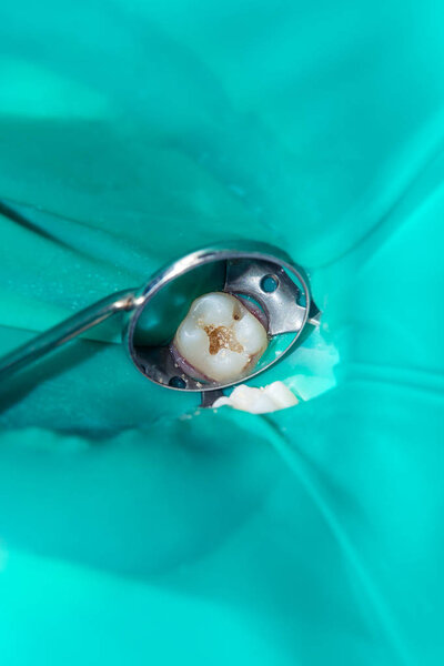 close-up of a human rotten carious tooth at the treatment stage in a dental clinic. The use of rubber dam system with latex scarves and metal clips, production of photopolymeric composite fillings