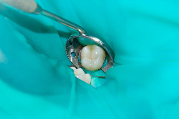 крупным планом гнилого кариозного зуба человека на стадии лечения в стоматологической клинике. Использование системы резиновых плотин с латексными шарфами и металлическими зажимами, производство фотополимерных композитных пломб
