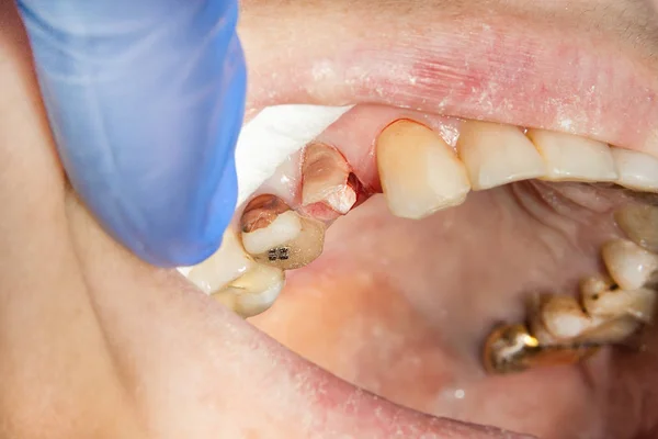에이펙스 클램프 끝마칠에 그것에 치아의 Endodontic Endodontic — 스톡 사진