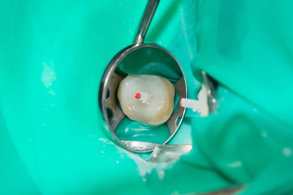 Tratamento Fotoendodôntico Canais Dentários Molar Inferior Molar Permanente Com Arquivo — Fotografia de Stock