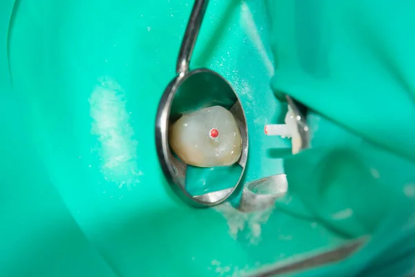 Tratamento Fotoendodôntico Canais Dentários Molar Inferior Molar Permanente Com Arquivo — Fotografia de Stock