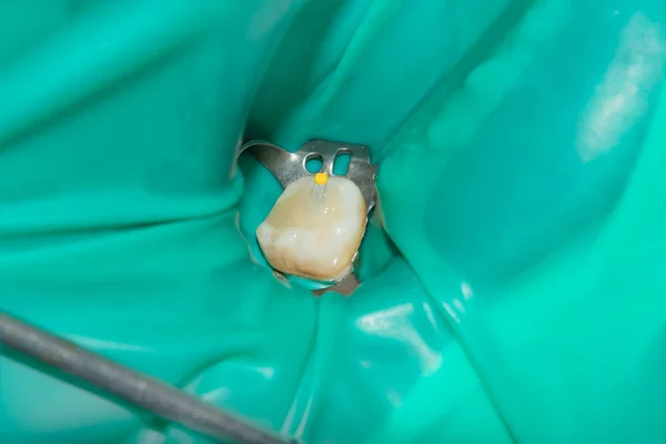 photo endodontic treatment of dental canals in the lower molar permanent tooth molar with endodontic file with apex locator, tooth with clamp attached to it by cofferdam