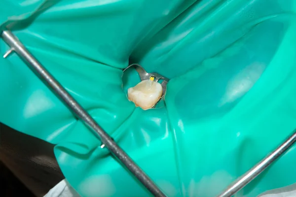 photo endodontic treatment of dental canals in the lower molar permanent tooth molar with endodontic file with apex locator, tooth with clamp attached to it by cofferdam