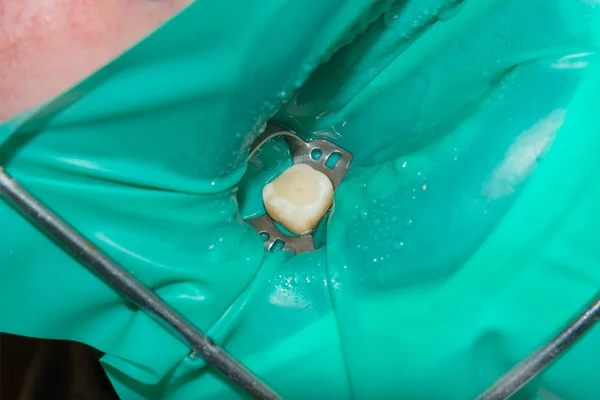 Foto Endodontische Behandeling Van Tandheelkundige Grachten Lagere Molaire Permanente Tand — Stockfoto