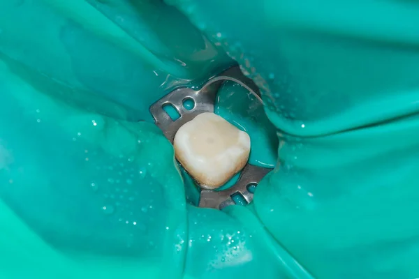 頂点のロケーター 締切りによってそれに接続されているクランプの歯とモルの永久歯歯臼歯歯内療法ファイルとの低い歯科の運河写真歯内治療 — ストック写真