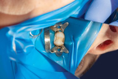 Bir insan dişi yakın çekim çürük tedavisinde. Kompozit malzeme ile diş diş restorasyon kavramı.